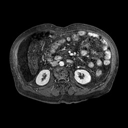 File:Cirrhosis and hepatocellular carcinoma in the setting of hemochromatosis (Radiopaedia 75394-86594 Axial T1 C+ fat sat 187).jpg