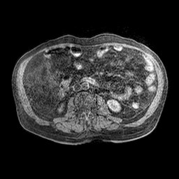 Cirrhosis and hepatocellular carcinoma in the setting of hemochromatosis (Radiopaedia 75394-86594 Axial T1 C+ fat sat 4).jpg