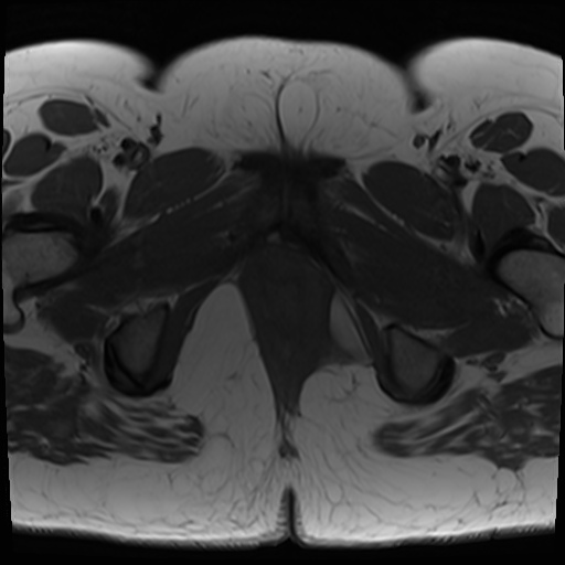 File:Class II Mullerian duct anomaly- unicornuate uterus with rudimentary horn and non-communicating cavity (Radiopaedia 39441-41755 Axial T1 27).jpg