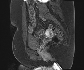 File:Class II Mullerian duct anomaly- unicornuate uterus with rudimentary horn and non-communicating cavity (Radiopaedia 39441-41755 G 67).jpg