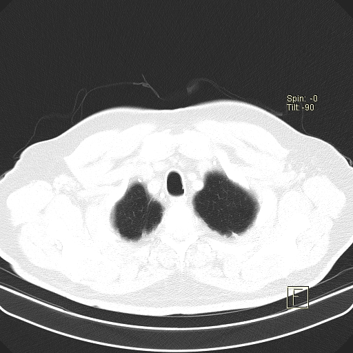 Classic complicated silicosis (Radiopaedia 49720-54961 Axial lung window 3).jpg