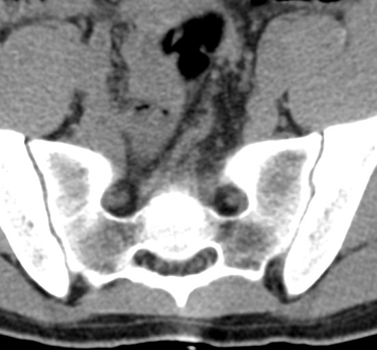 File:Clear cell meningoma - lumbar spine (Radiopaedia 60116-67691 Axial non-contrast 76).png