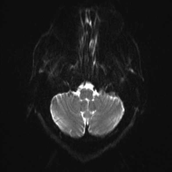 File:Clival meningioma (Radiopaedia 53278-59248 Axial DWI 3).jpg