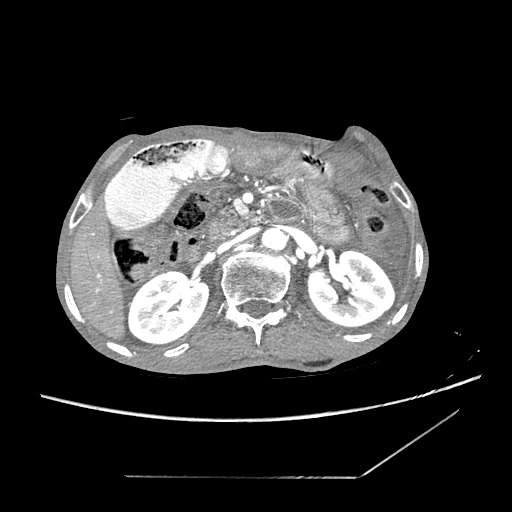 Closed-loop obstruction due to peritoneal seeding mimicking internal hernia after total gastrectomy (Radiopaedia 81897-95864 A 51).jpg