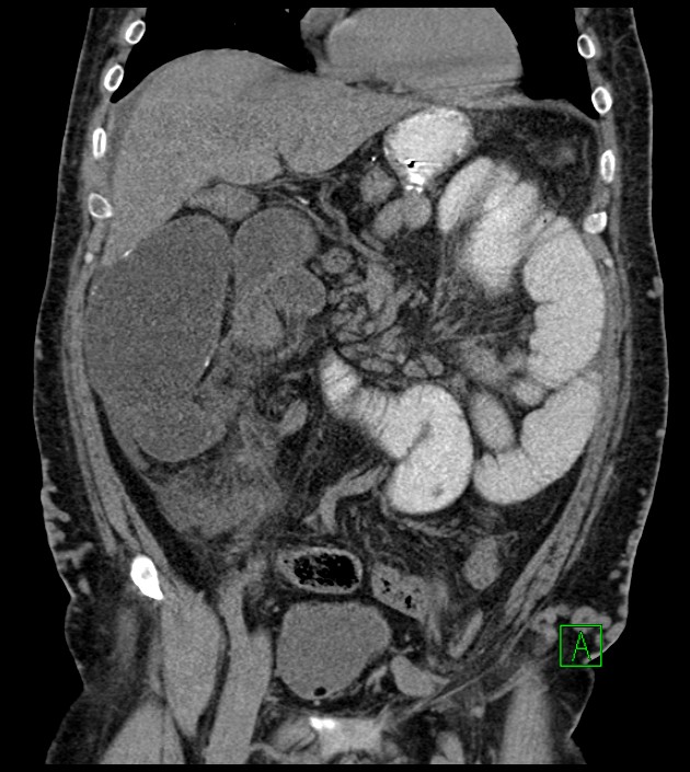 Closed-loop small bowel obstruction-internal hernia (Radiopaedia 78439-91096 Coronal non-contrast 42).jpg