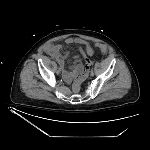 Closed loop obstruction due to adhesive band, resulting in small bowel ischemia and resection (Radiopaedia 83835-99023 Axial non-contrast 126).jpg