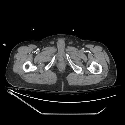 Closed loop obstruction due to adhesive band, resulting in small bowel ischemia and resection (Radiopaedia 83835-99023 B 169).jpg