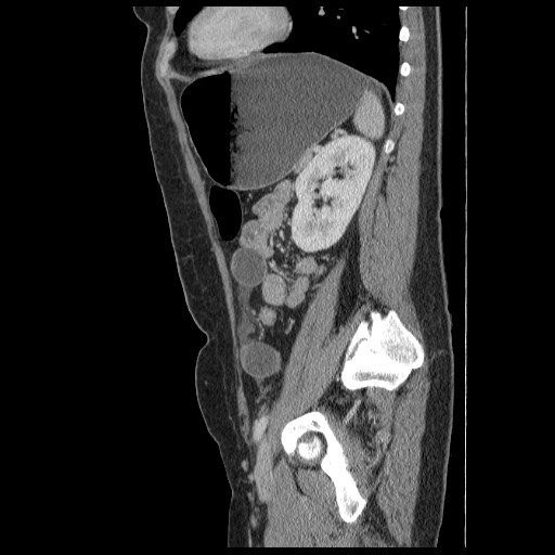 File:Closed loop small bowel obstruction (Radiopaedia 65403-74451 C 76).jpg