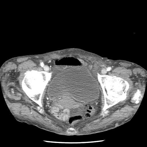 Closed loop small bowel obstruction - adhesions and infarct (Radiopaedia 85125-100678 B 97).jpg