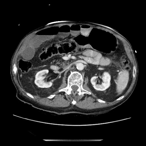 File:Closed loop small bowel obstruction - adhesive disease and hemorrhagic ischemia (Radiopaedia 86831-102990 A 80).jpg