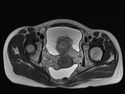 Closed loop small bowel obstruction in pregnancy (MRI) (Radiopaedia 87637-104031 D 34).jpg