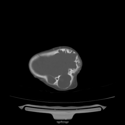 Cloverleaf skull (Radiopaedia 91901-109710 Axial bone window 132).jpg