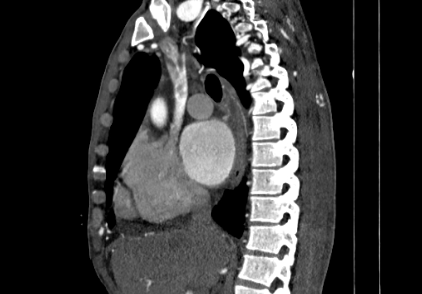 Coarctation of aorta with aortic valve stenosis (Radiopaedia 70463-80574 B 33).jpg