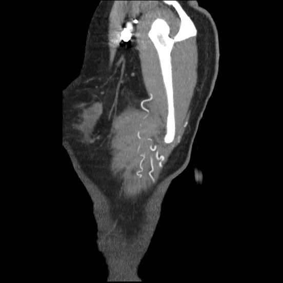 Coarctation of the aorta (Radiopaedia 67609-77010 C 2).jpg