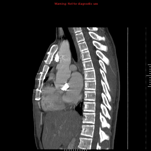 Coarctation of the aorta (Radiopaedia 9434-10118 B 27).jpg