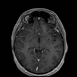 Cochlear incomplete partition type III associated with hypothalamic hamartoma (Radiopaedia 88756-105498 Axial T1 C+ 95).jpg