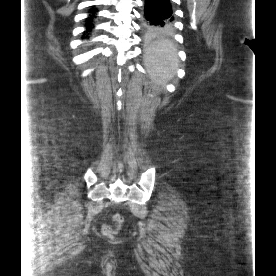 File:Collection due to leak after sleeve gastrectomy (Radiopaedia 55504-61972 B 39).jpg