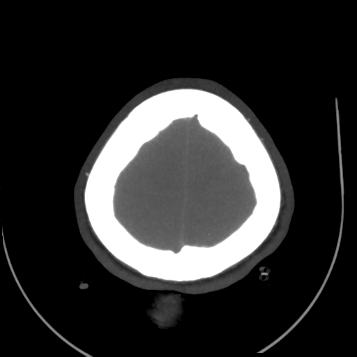 File:Colloid cyst (resulting in death) (Radiopaedia 33423-34499 A 51).png