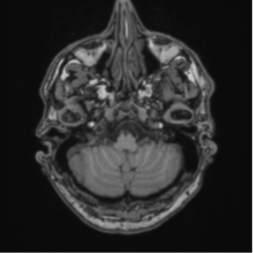 File:Colloid cyst of the third ventricle (Radiopaedia 86571-102662 Axial T1 17).png