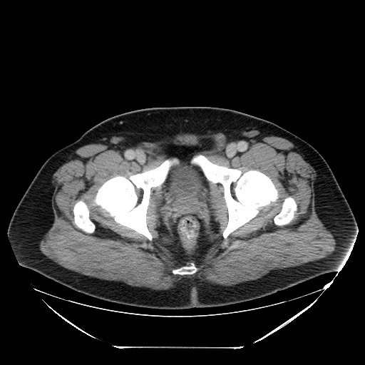 Colocolic intussusception due to lipoma (Radiopaedia 73712-84508 A 112).jpg