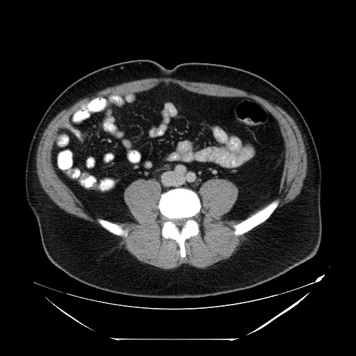 Colocolic intussusception due to lipoma (Radiopaedia 73712-84508 A 74).jpg