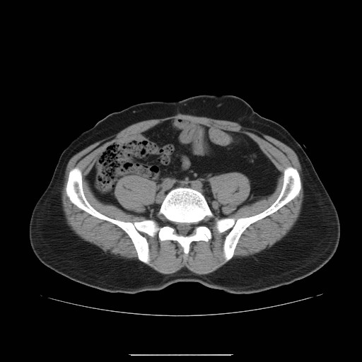 File:Colocutaneous fistula in Crohn's disease (Radiopaedia 29586-30093 Axial non-contrast 23).jpg