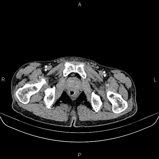 File:Colon adenocarcinoma - hepatic flexure (Radiopaedia 85635-101395 A 99).jpg
