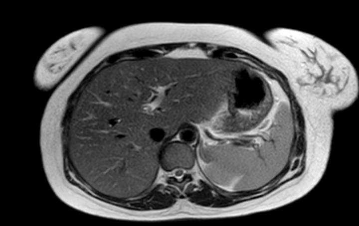 Colon adenocarcinoma with Krukenberg tumors, advanced pregnancy (Radiopaedia 67279-76645 Axial T2 68).jpg