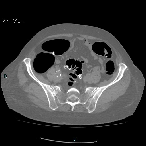 Colonic lipomas (Radiopaedia 49137-54244 Axial bone window 150).jpg