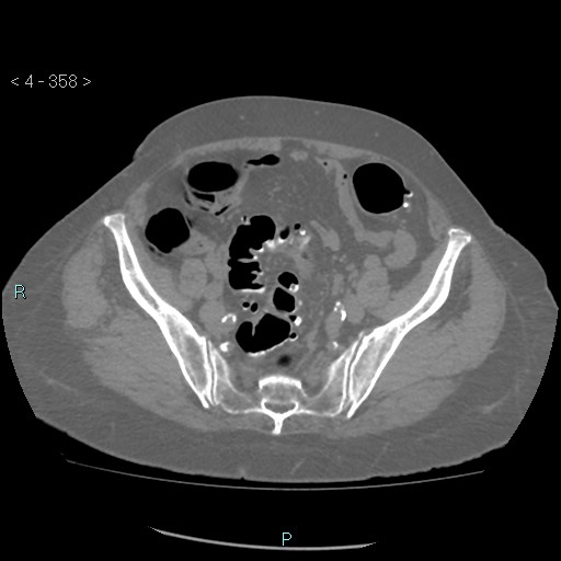 File:Colonic lipomas (Radiopaedia 49137-54244 Axial bone window 160).jpg