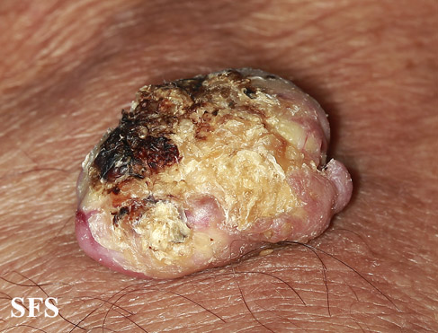 File:Keratoacanthoma (Dermatology Atlas 49).jpg