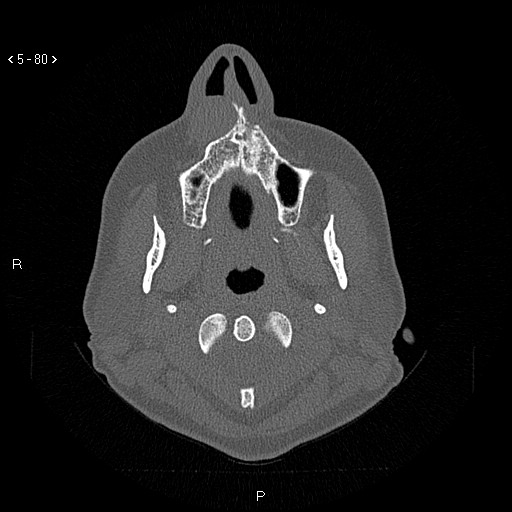 Nasolabial cyst (Radiopaedia 75125-86194 Axial bone window 41).jpg