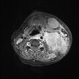 Nasopharyngeal carcinoma- T4,N3b (Radiopaedia 59376-67000 Axial T1 C+ fat sat 49).jpg