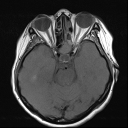 File:Nasopharyngeal carcinoma with cerebral abscess (Radiopaedia 43018-46273 Axial T1 11).png