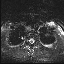 File:Nasopharyngeal carcinoma with skull base invasion (Radiopaedia 59258-66600 Axial T2 fat sat 21).jpg