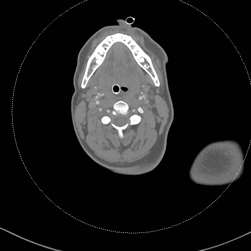 Neck CT angiogram (intraosseous vascular access) (Radiopaedia 55481-61945 B 203).jpg