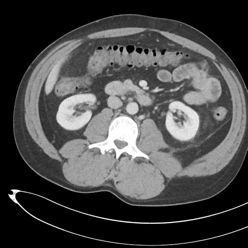 File:Necrotizing pancreatitis with acute necrotic collections (Radiopaedia 38829-41012 B 41).png