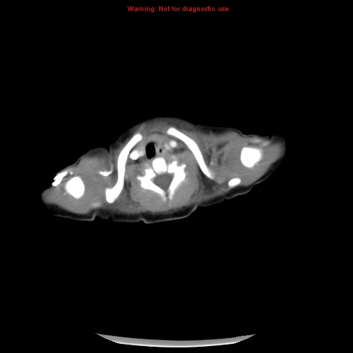 File:Neonatal neuroblastoma (Radiopaedia 9564-10223 A 1).jpg