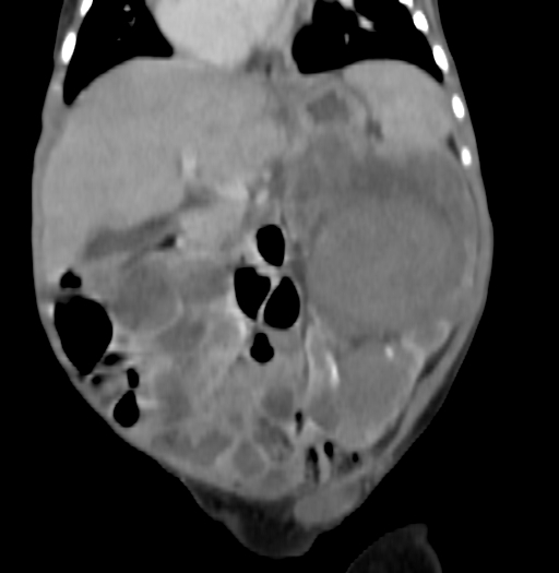 Nephroblastomatosis (Radiopaedia 71294-81607 B 172).jpg
