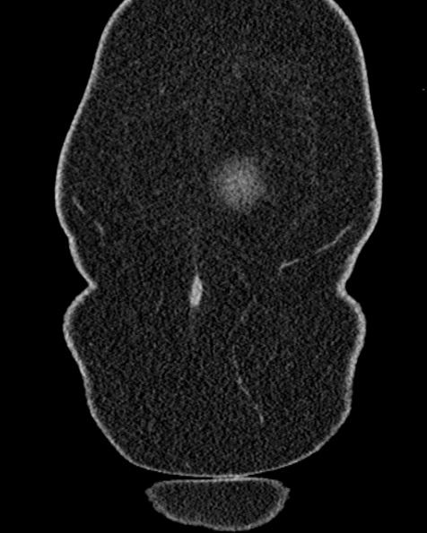 File:Nephrostomy for urosepsis (Radiopaedia 26180-26330 non-contrast 7).jpg