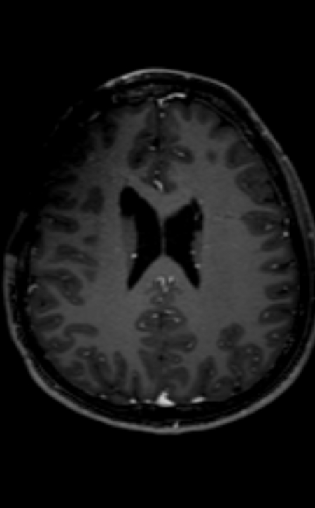 Neuro-Behçet disease (Radiopaedia 90112-107294 Axial T1 C+ 104).jpg