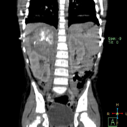 File:Neuroblastoma (Radiopaedia 24751-25016 B 17).jpg