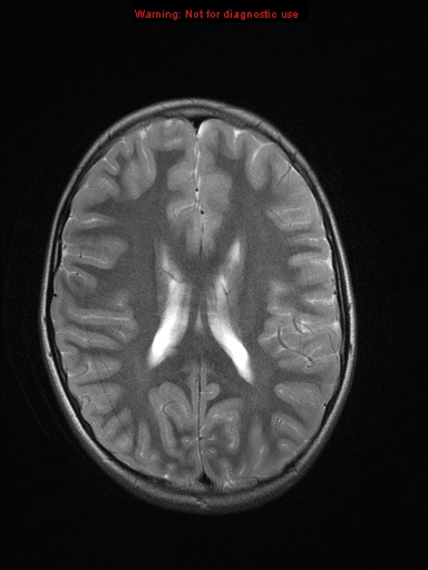 File:Neurofibromatosis type 1 with optic nerve glioma (Radiopaedia 16288-15965 Axial T2 10).jpg