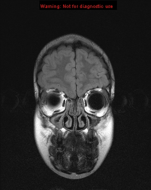 File:Neurofibromatosis type 1 with optic nerve glioma (Radiopaedia 16288-15965 Coronal FLAIR 22).jpg