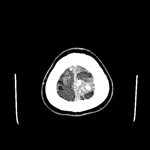 File:Neurofibromatosis type 2 (Radiopaedia 25389-25637 Axial C+ 97).jpg