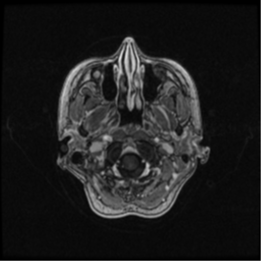 Neurofibromatosis type 2 (Radiopaedia 45229-49244 Axial T1 C+ 25).png