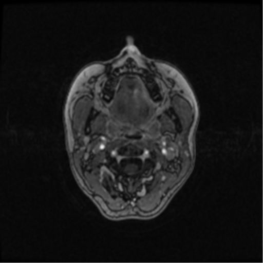Neurofibromatosis type 2 (Radiopaedia 45229-49244 Axial T1 C+ 7).png