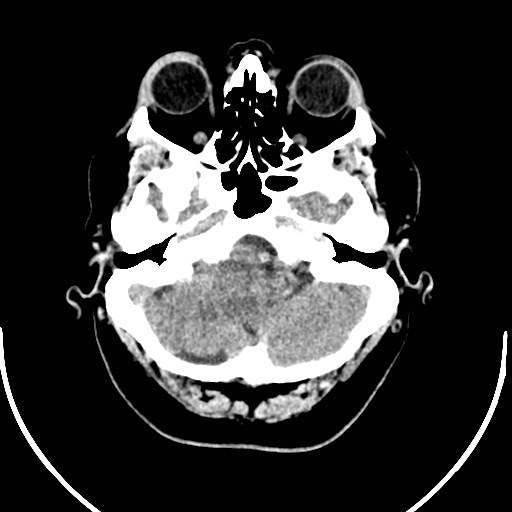 Neurofibromatosis type 2 (Radiopaedia 79097-92047 Axial non-contrast 10).jpg