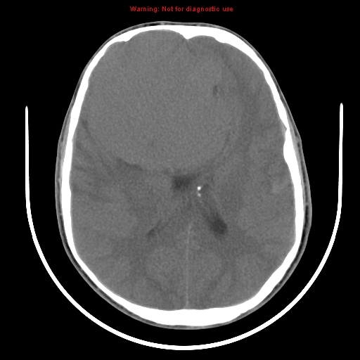 File:Neurofibromatosis type 2 (Radiopaedia 8953-9732 Axial non-contrast 21).jpg