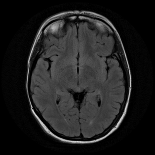 File:Neurofibromatosis type 2 - bilateral acoustic neuromata (Radiopaedia 40060-42566 Axial FLAIR 10).png